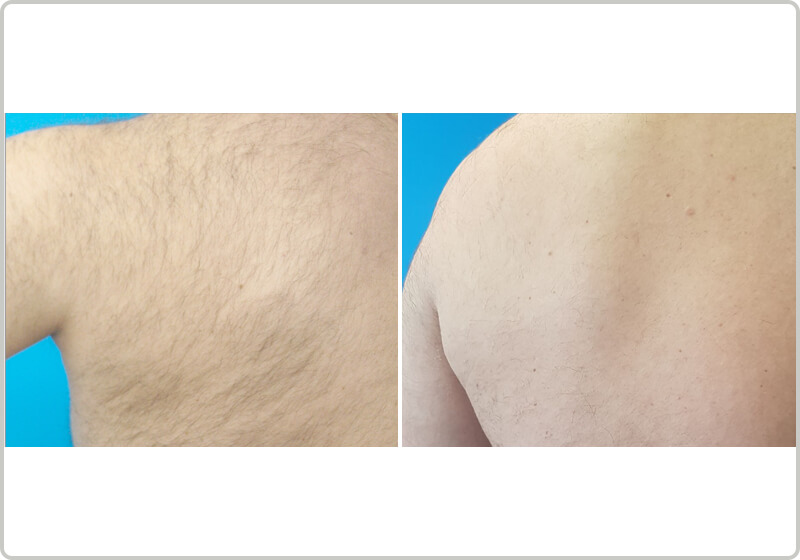 Before and after laser hair removal of a back
