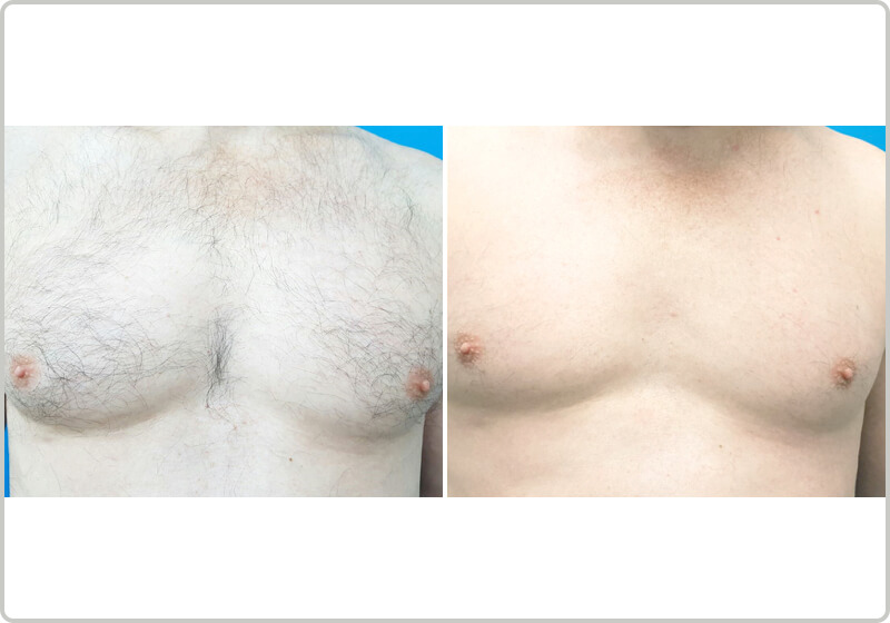 Before and after laser hair removal of a chest