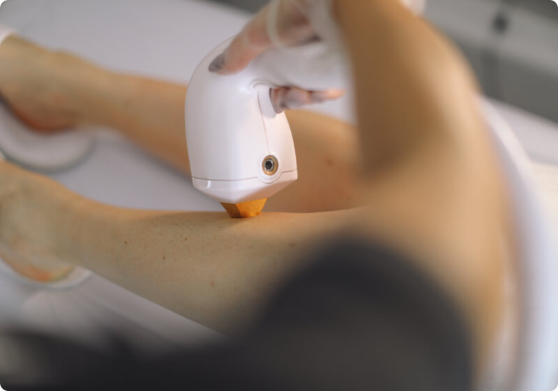 Therapist performing laser hair removal on a leg
