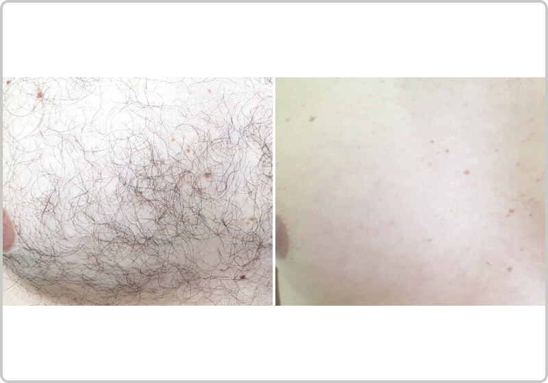 Before and after laser hair removal of a pectoral