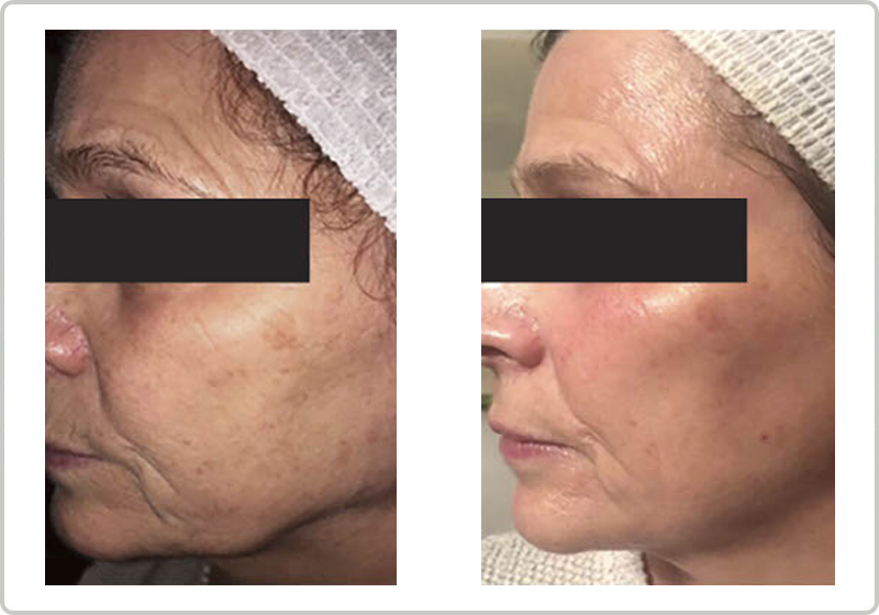 anti ageing before and after