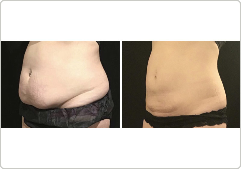 Coolsculpting before and after